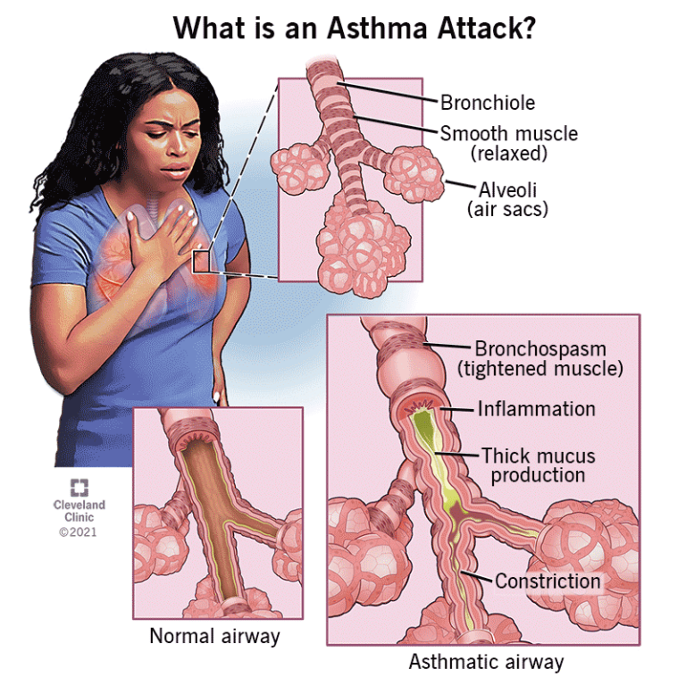 6424-asthma